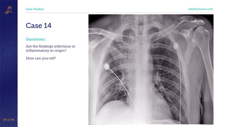 online CME poster Evaluation of Chest X-Rays: Pattern Based Techniques Using a Cased Based Approach (Part 2 of 2)
