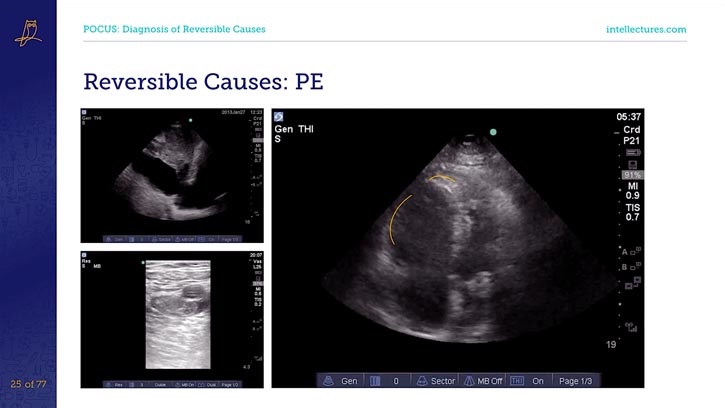 online CME poster POCUS in Cardiac Arrest: An Evidence-Based Approach
